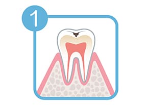 軽度のむし歯(C1)