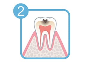 軽度のむし歯(C1)