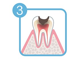 軽度のむし歯(C1)