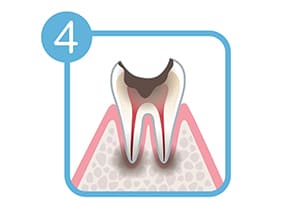 最重度のむし歯（C4）
